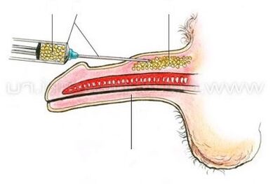 通过注射增大阴茎